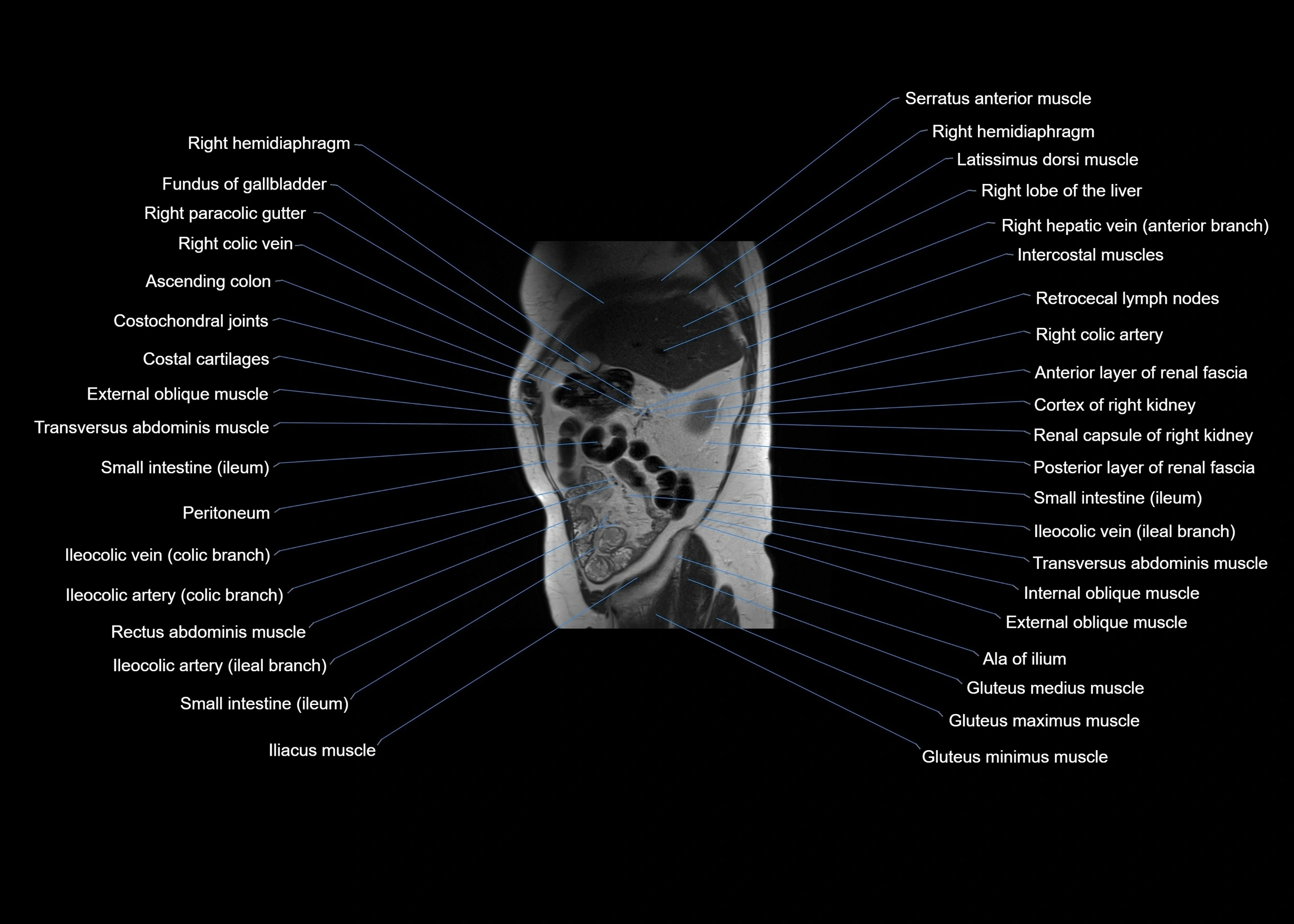 MRI abdomen sagittal cross sectional anatomy  radiology  image-img-00001-00016.webp